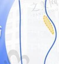 陈万芳5D自体脂肪丰臀79600元起,术后恢复期短存活率高