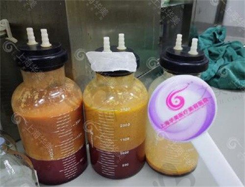 上海何斌吸脂怎么样狠不狠,腰腹吸脂两万起口碑也不错！