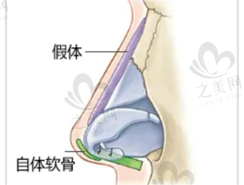 深圳刘冰做隆鼻技术好