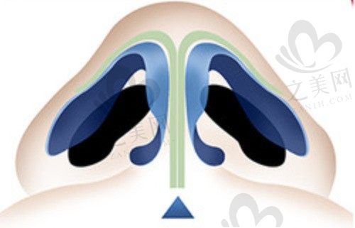 吴玉家做鼻综合怎么样？半肋鼻修复技术高成效牛价格5.7W起