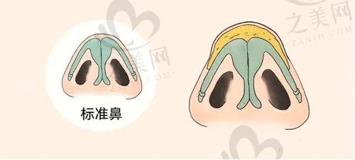 杭州美莱李波鼻子做的怎么样?不仅鼻综合技术好隆鼻修复值得夸