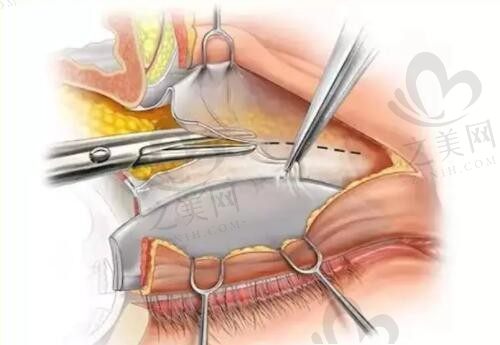 孙峰修复双眼皮技术很不错,在线即可预约孙峰手术,眼修复28000元起