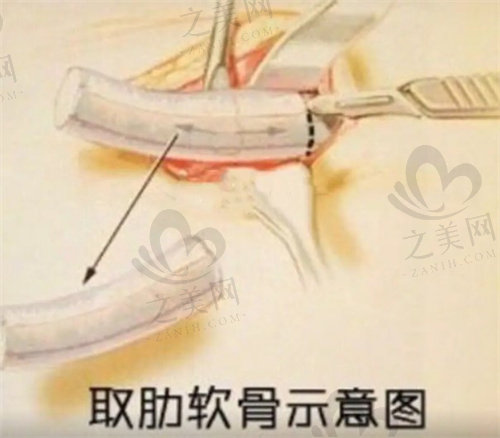 肋软骨隆鼻示意图