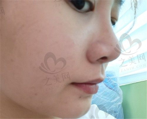 说起深圳的刘冰医生技术够不够格?给我做的耳软骨隆鼻真的牛