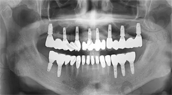 种植牙有五大危害是真是假？