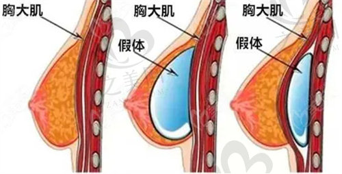 余成坤隆胸价格多少？