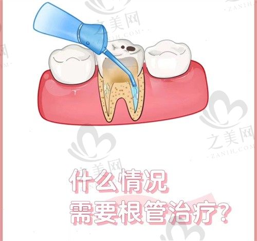 想知道重庆美奥口腔医院是否正规,先看黄泽源根管治疗收费情况判