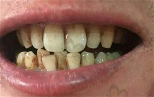 牙齿去黄小妙招来了,看哪款牙膏可以去黄美白牙齿