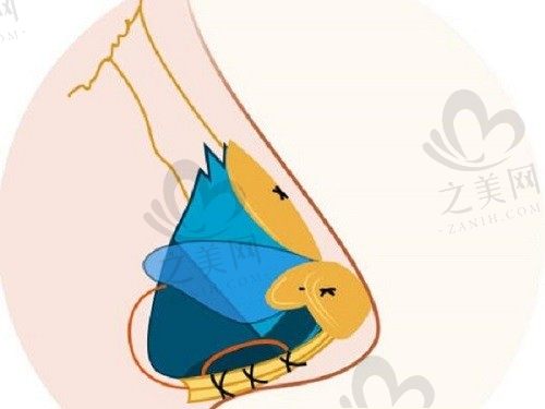 师俊莉做鼻子真的好呢！师俊莉妈生款美鼻双侧耳软骨隆鼻49000元起