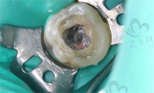 什么情况的牙齿要做根管治疗?不做根管直接补牙可以吗?