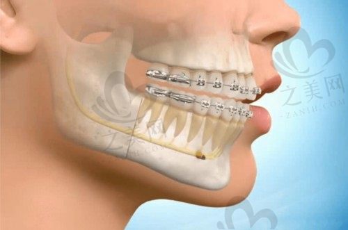 正颌和正畸手术联合治疗