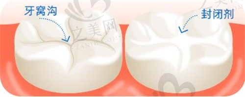 宝爸宝妈必备知识:窝沟封闭对孩子好吗?