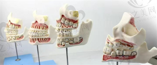恒牙替代乳牙萌出的儿童牙齿模型
