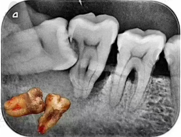 阻生智齿牙片