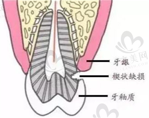 楔状缺损损伤牙釉质