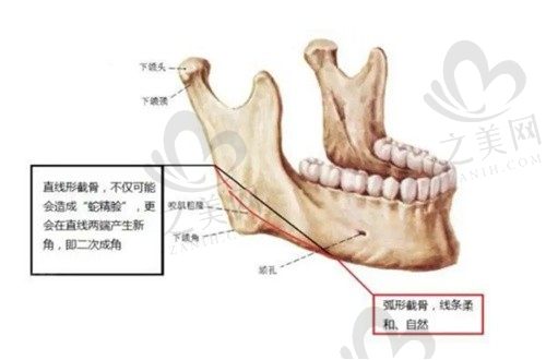 四川友谊罗恩磨骨怎么样？罗恩做下颌角磨骨有效瘦脸价格52560元起