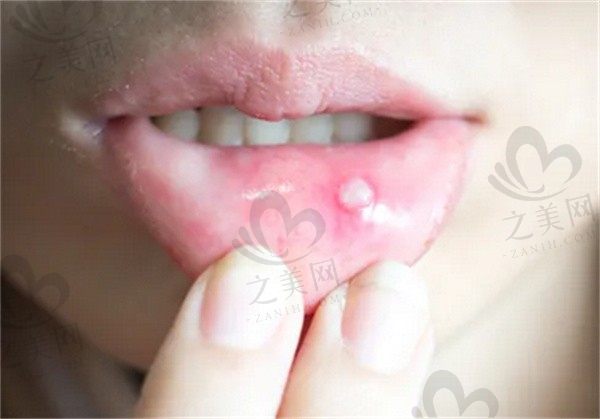 牙齿酸和口腔溃疡有关系吗?牙齿酸是怎么回事,什么原因?