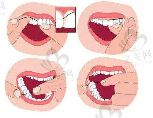 牙线清洁口腔