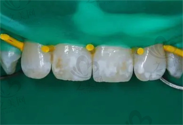 大门牙上有白色的斑块怎么去除？