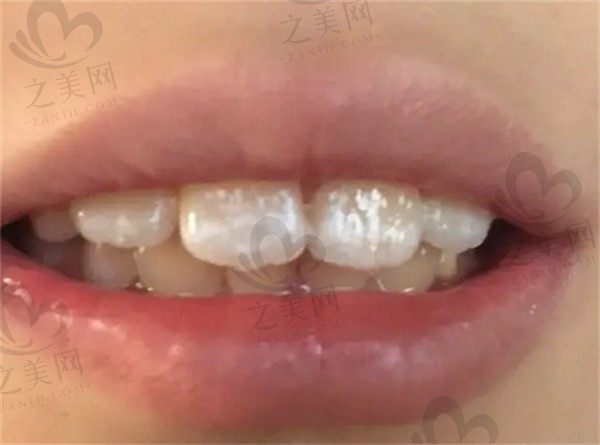 牙齿白斑自己能修复吗?大门牙上有白色的斑块怎么去除?