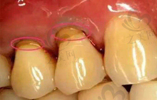 牙齿楔状缺损的修复方法1