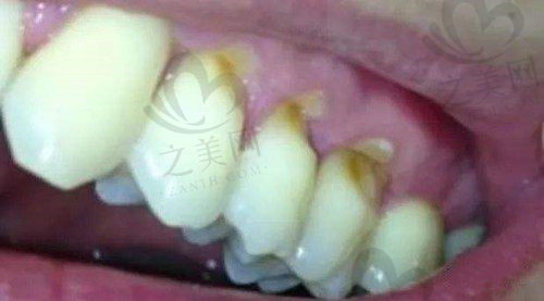 牙齿楔状缺损的修复方法2