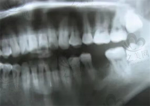 牙齿残根牙片
