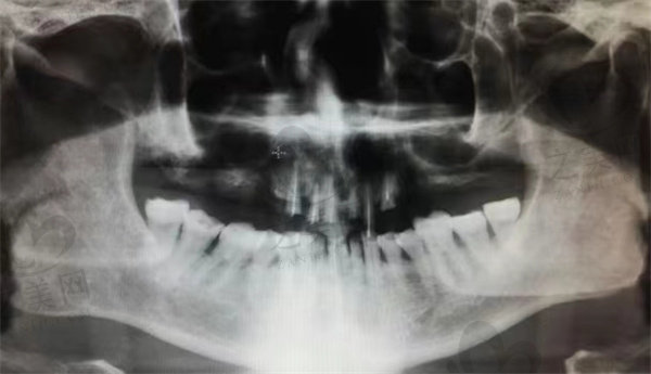 牙齿残根牙片