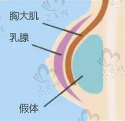 杭州栗勇隆胸技术怎么样？栗勇做傲诺拉假体隆胸划算价格10w起 