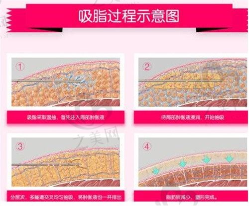 上海富贵包手术多少钱?华美/薇琳/美联臣便宜又好!