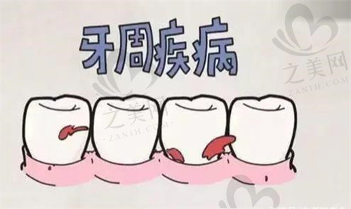 牙周炎属于牙周疾病