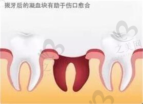 拔牙之后的凝血块有助于伤口愈合