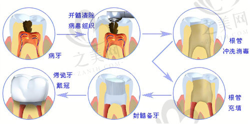 根管治疗