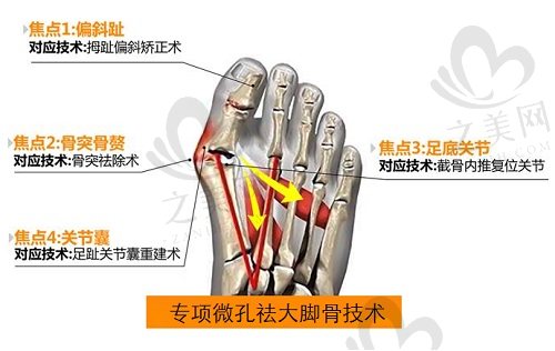 北京圣嘉新大脚骨手术技术优势