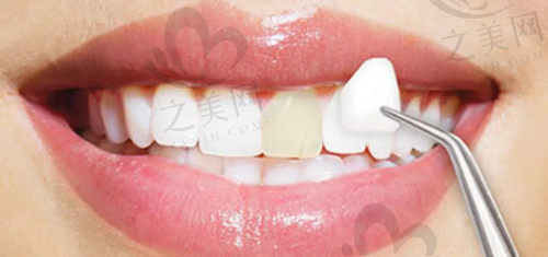 牙齿美白修复方式