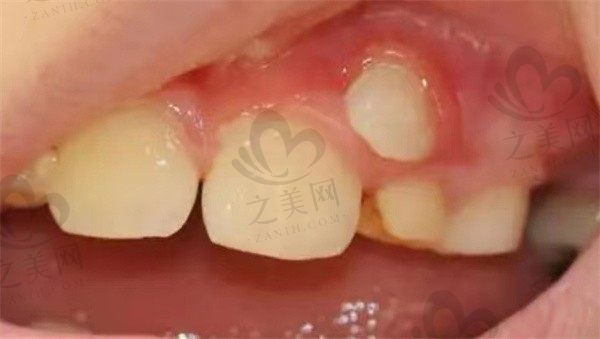 恒牙长歪会自动调整吗?恒牙长歪是什么原因,怎么办?