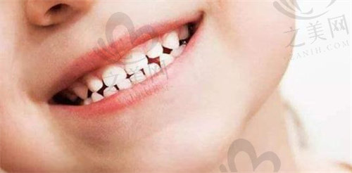 孩子牙齿萌出时会有缝隙是正常的