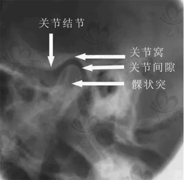 颞下颌关节示意图