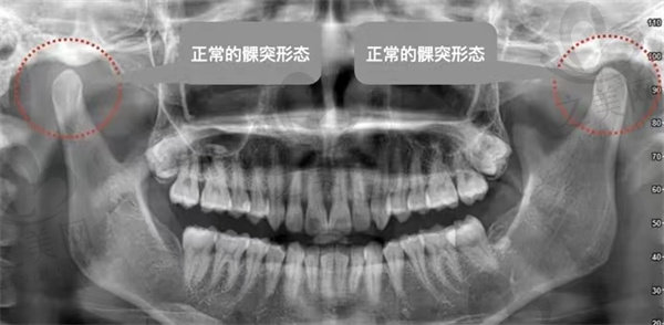 颞下颌面的正常髁突形态牙片