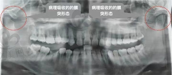 颞下颌面的病理吸收髁突形态牙片