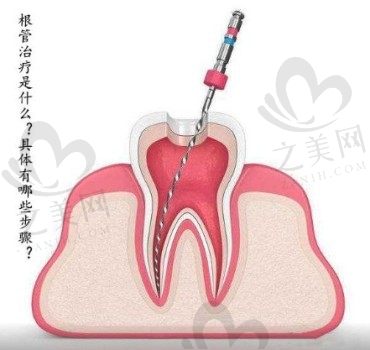 做过根管治疗的牙能用几年?牙齿根管治疗环节