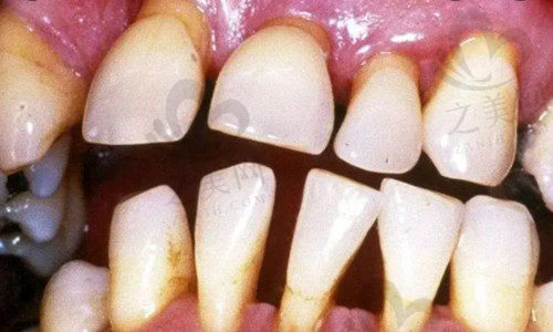 牙齿萎缩的原因3