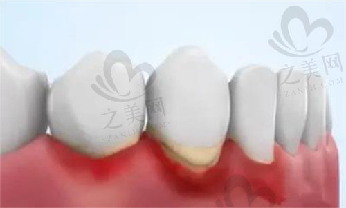 牙龈萎缩常伴随牙周炎