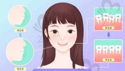 成年以后千万别整牙,带牙套1~12月变化图让你惊喜。