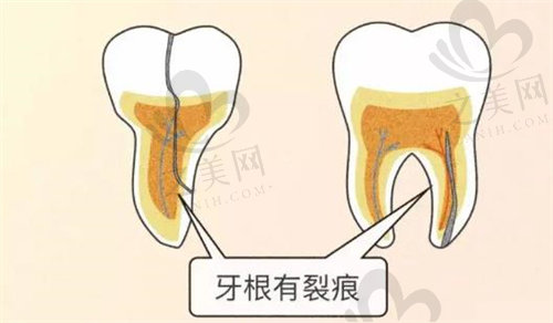 牙根有裂缝会发展到在牙齿表面