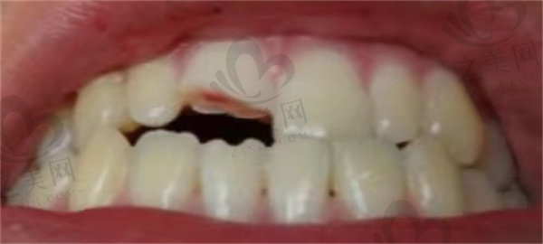 牙齿断裂图片