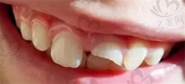 牙齿断裂图片