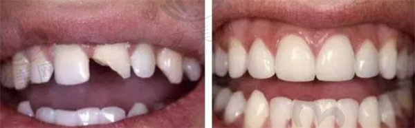 牙齿断裂与牙齿修复对比图