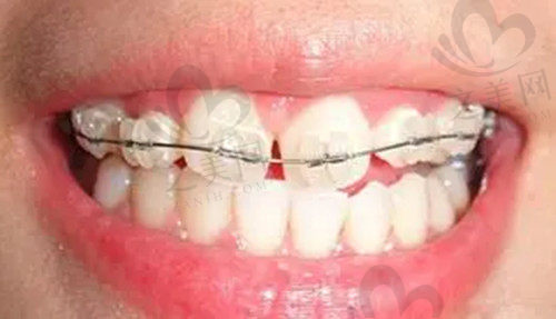 牙缝隙变大预防方法