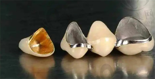 牙冠的多种材料
